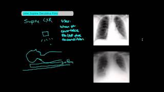 Types of Chest XRays part 2  Lateral Supine Decubitus UndergroundMed [upl. by Artimid]