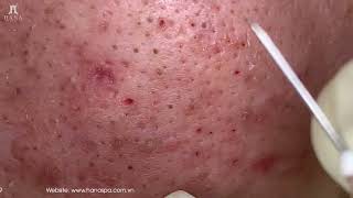 Big Cystic Acne Blackheads Extraction Blackheads amp Milia Whiteheads Removal Pimple Popping [upl. by Boys527]