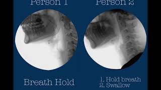 Swallowing postures and maneuvers with videofluoroscopy two healthy adults [upl. by Yelahc]