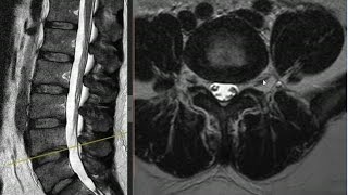 RM Anatomia da Coluna Lombar [upl. by Anirda]