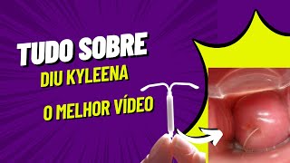 DIU KYLEENA  Como é a colocação Dói Demora Quanto tempo dura [upl. by Merce]