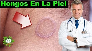 Aprende Como Eliminar Los Hongos De La Piel Combatelos Con Estos Remedios Que Me Funcionaron [upl. by Ganley]