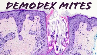 Demodex Mites under the microscope Demodex folliculorum amp Demodex brevis demodex mites on face [upl. by Nordek355]