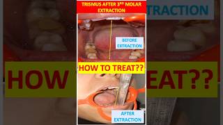 How to treat trismus after 3rd molar Extraction dentalcafe4331 [upl. by Glennon557]