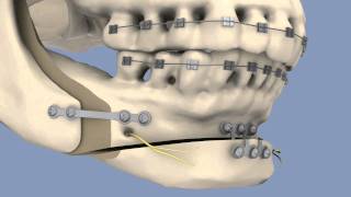 BSSO amp Osseous Genioplasty [upl. by Ennaira]