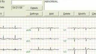 ECG recording with eClinicalWorks [upl. by Aldus]