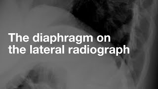 The Diaphragm on the Lateral CXR [upl. by Warram440]