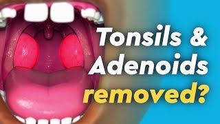 Tonsils and Adenoids Surgery [upl. by Ahtnams142]