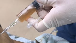 Como Hacer Una PARACENTESIS Abdominal  Prácticas De Enfermería  enfermeria viralvideo [upl. by Leoj10]