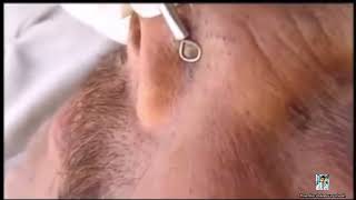 Ultimate Pimple Popping 2024 Amazing Pimple Removals [upl. by Lein208]