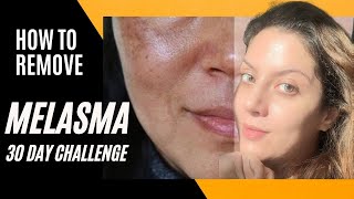 Melasma Removal at Home I Melasma Remove cream I Melasma Skin Care Regimen Routine [upl. by Esirehs331]