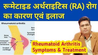 Rheumatoid Arthritis Cause Symptoms Diagnosis and Treatment  in Hindi [upl. by Eula]