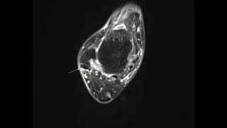 Peroneus brevis split tear [upl. by Madelaine]