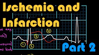 Ischemia Infarction and the Waveforms Q through U Part 2 How to Read an EKG Curriculum [upl. by Mota686]