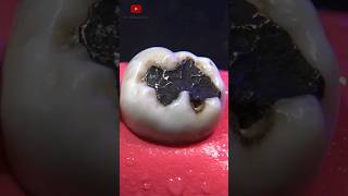 Restauración dental satisfying [upl. by Stilla179]