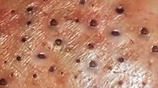 Deep blackhead extraction Cystic acne amp pimple popping 86 [upl. by Alyosha]