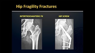 Fragility Fractures [upl. by Hole]