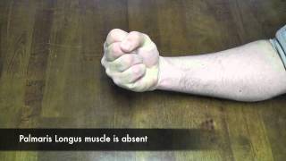 Thompsons Test for Palmaris Longus CR [upl. by Aehsa501]