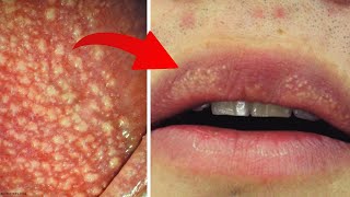 How to Get Rid of Fordyce Spots  Fordyce Spots Treatment at Home  Home Remedies for Fordyce Spots [upl. by Wasserman]