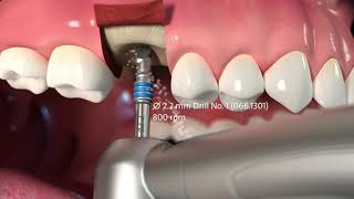 Pose dun implant dentaire monobloc [upl. by Cristobal]