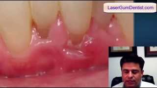 Frenectomy in Los Angeles with Laser Gum Dentist Periolase [upl. by Binnie747]