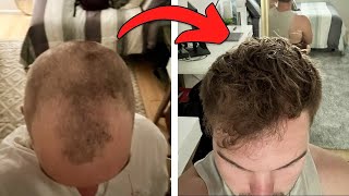 How I Fixed My Hairline Naturally NO SURGERY NEEDED [upl. by Sandeep]