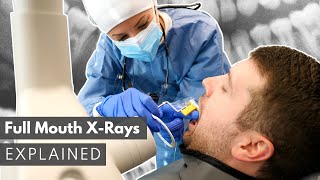 Dental XRay Full Mouth Series FMX Explained [upl. by Seugram]