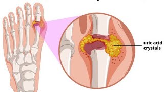 Gout ArthritisDefinitionPathophysiology Clinical manifestationsRisks Factors Treatment Hindi [upl. by Hsan229]