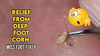 Relief from Deep Foot Corn Best Treatment Options By Foot Specialist Miss Foot Fixer [upl. by Viviyan]