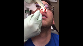 Deviated Septum Splint Removal [upl. by Adora]