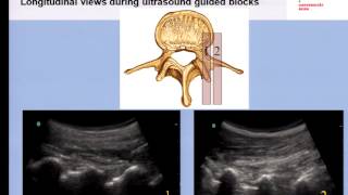 Pain Medicine  Lumbar Medial Branch Facet Joint and Nerve Root Blocks [upl. by Arihs186]