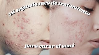 Dos meses de tratamiento para el acné  doxiciclina clindamicina y epiduo gel [upl. by Mccourt253]