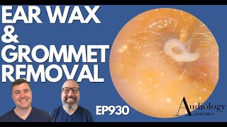 PLASTIC TUBE STUCK IN EAR CANAL  EAR WAX REMOVAL  EP930 [upl. by Cilo]