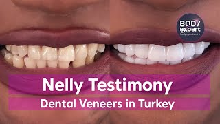 DENTAL CARE IN TURKEY  🦷 Nelly’s testimony 18 Emax dental veneers  BODYEXPERT [upl. by Blank967]