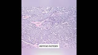 Granulosa cell tumor patterns pathologists cancer ovariancancer ovary histopathology modi ind [upl. by Thgirw328]