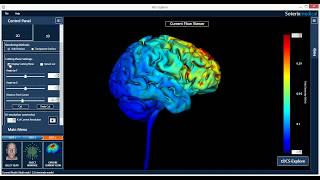 F3F4 anodal tDCS montage improves multiple sclerosis fatigue [upl. by Cyprus316]