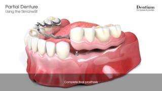 Partial denture [upl. by Otreblide]