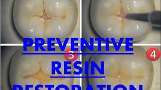 Preventive Resins Restorations I Dental Guide I Dr Bimal Chand I [upl. by Etiuqram]