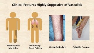 Vasculitis  An Overview [upl. by Naitsirk]