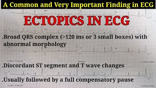 ECG Ectopics Explained  Learn about Ectopics APCs amp VPCs  Ventricular Trigeminy ECG [upl. by Romney]