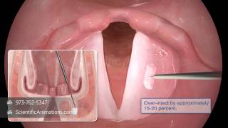 Vocal Cord Paralysis Surgery [upl. by Beauregard]