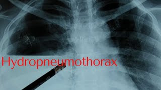 hydropneumothorax [upl. by Oigres]