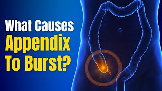 Appendicitis What are the signs causes and how to treat it  Acute Appendicitis  The Healthsite [upl. by Kass714]