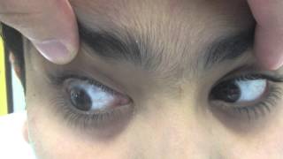 Downbeat nystagmus in a child with Arnold Chiari Malformation recently operated [upl. by Halyhs626]