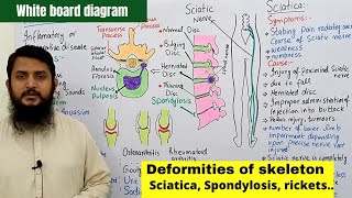 Deformities of skeleton part 02  Disc Slip  Spondylosis  Sciatica  Arthritis [upl. by Atsiuqal]