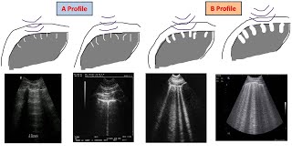 Lecture 4 Lung US in interstitial syndrome [upl. by Ermentrude]