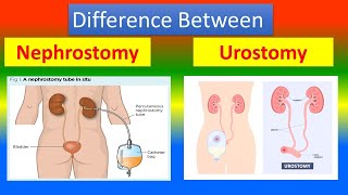 Difference between Nephrostomy and Urostomy [upl. by Mij79]