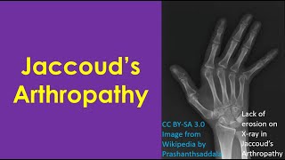 Jaccoud’s Arthropathy [upl. by Herates]