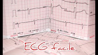 ECG facile  approche pratique [upl. by Aimar771]