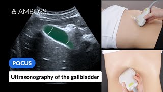 Point of Care Ultrasound of the Gallbladder  AMBOSS Video [upl. by Mildrid]